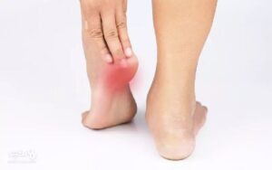 آنچه باید درباره درد پاشنه بدانیم
