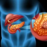 ارتباط متابولیسم اسید صفراوی با پیش‌آگهی از سرطان کولورکتال