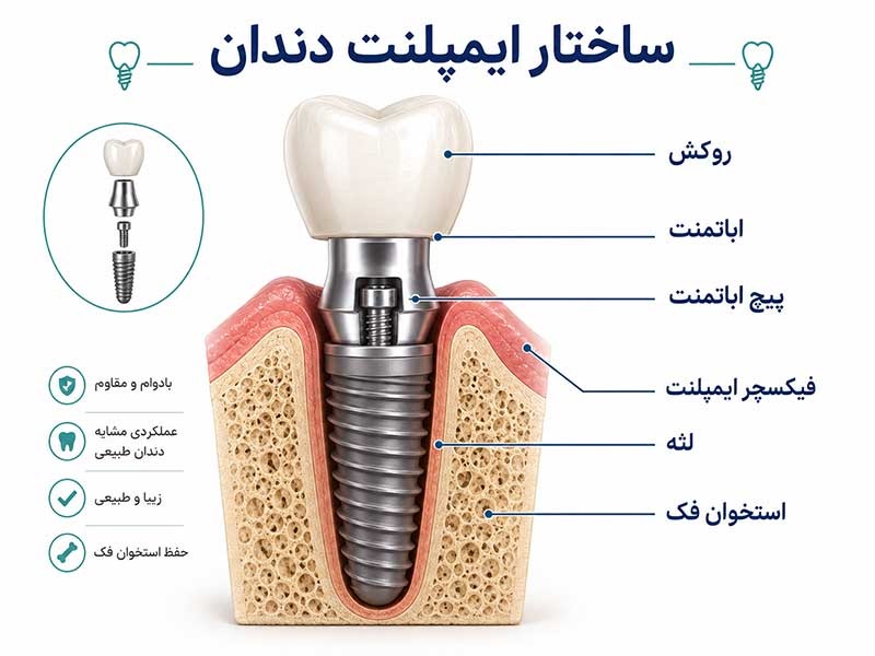 آیا ایمپلنت همیشه بهترین انتخاب است؟